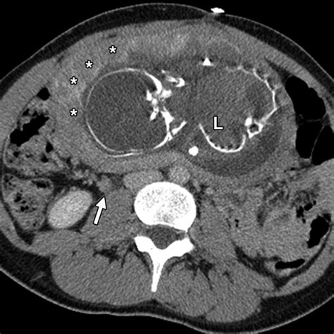 Imaging of Trauma: Part 2, Abdominal Trauma and Pregnancy—A Radiologist ...