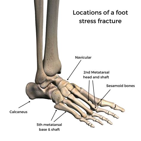 Stress Fracture: Causes, Symptoms & Treatment | The Feet People Podiatry