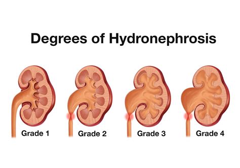 Renal Ultrasound | Sonoguide