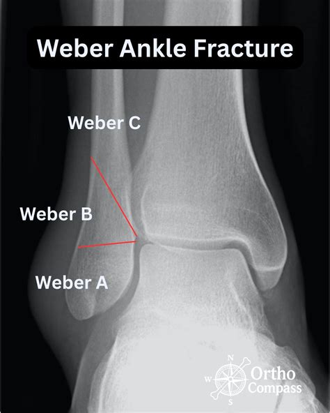 Understanding Ankle Fractures: Weber Classification Explained | Ortho Compass posted on the ...