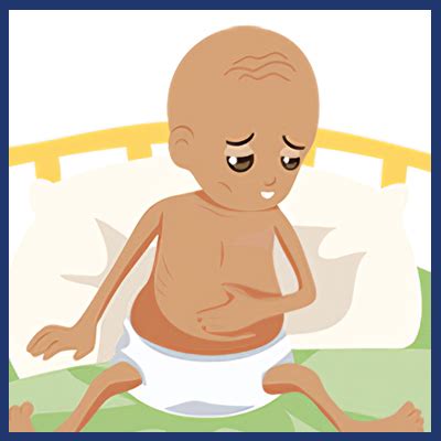 homeopathic treatment for Marasmus in homeopathy, Marasmus Treatment in ...