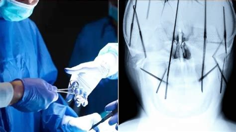 তরুণীর মাথা থেকে ৭৭টি সূঁচ বের করলেন চিকিৎসকরা! কীভাবে ঢুকল? চমকে ...