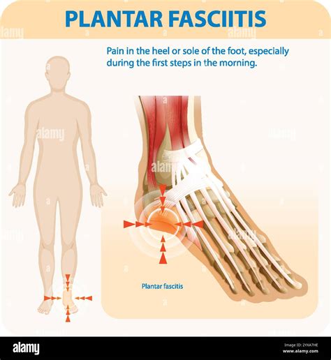 Illustration of foot anatomy and pain points Stock Vector Image & Art - Alamy