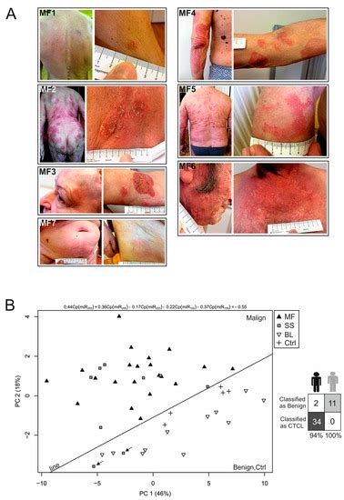 IJMS | Special Issue : Non-Coding RNAs and Epigenetics in Cancer ...