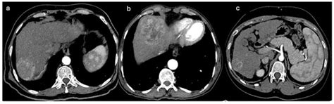Selective Angiographic Roadmap Analysis (SARA) of Hepatocellular ...