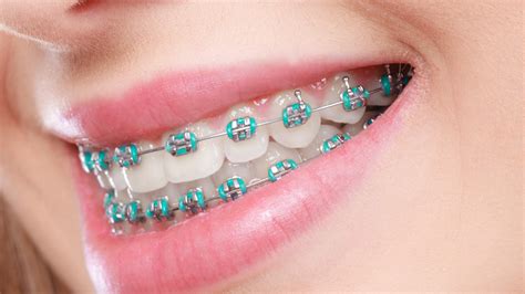 Traditional Braces Chino Hills, CA | Gordon Ranch Dentistry