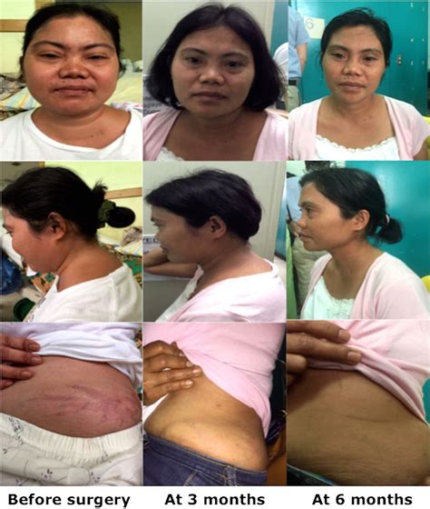 Cushing's Syndrome Surgery