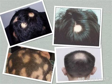 郑州皮肤科丨斑秃是什么原因造成的？怎么治疗比较好？ - 知乎