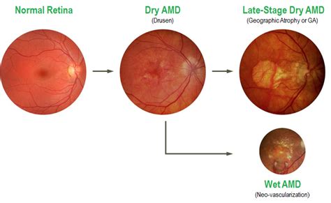 Wet Macular Degeneration – Exult Diagnostics