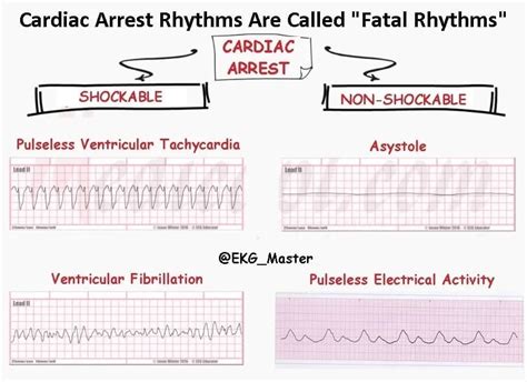 EKG_Master | Shockable and non-shockable cardiac arrest rhythms ...