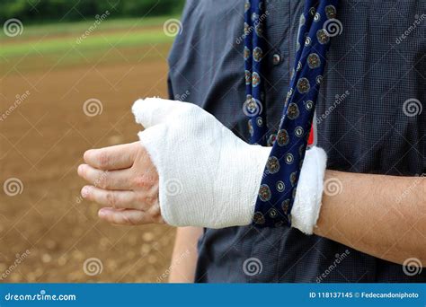 Hand of the Injured Person after the Fracture of the Bone Stock Image ...
