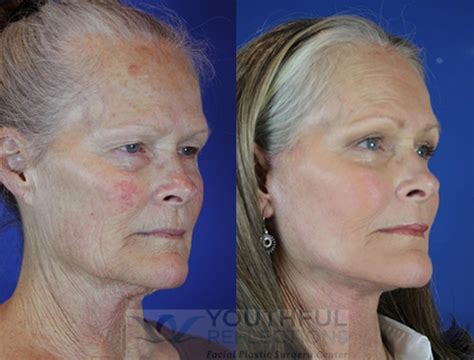 CO2 Laser Skin Resurfacing Before & After Photos Patient 24 | Nashville, TN | Youthful Reflections