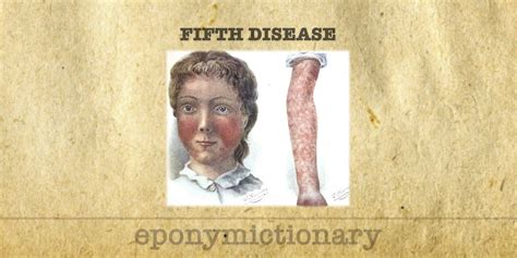 Fifths Disease