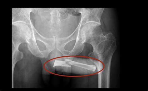 Penile Fracture X Ray