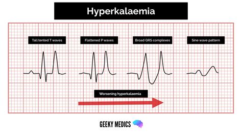 R Wave Progression