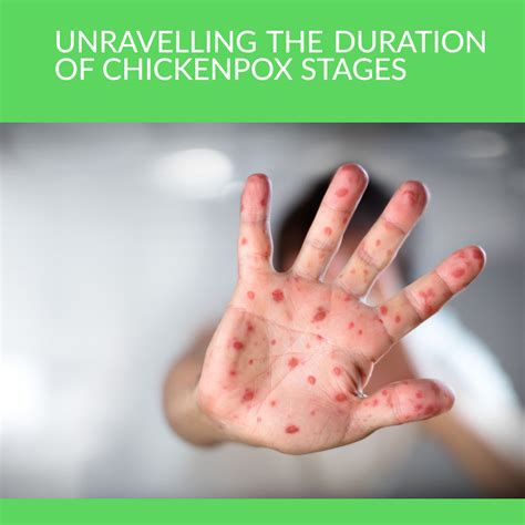 Chicken Pox Stage 1