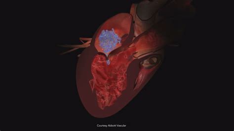 Leaky Heart Valve? There's A "Clip" For That! | wfmynews2.com