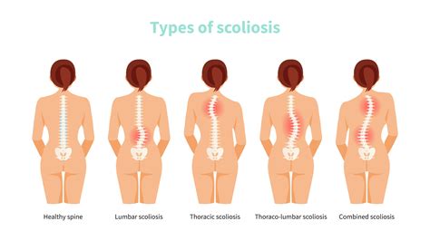 Scoliosis: What Causes It? - YogaUOnline