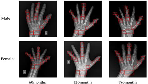Automated Bone Age Assessment: A New Three-Stage Assessment Method from ...