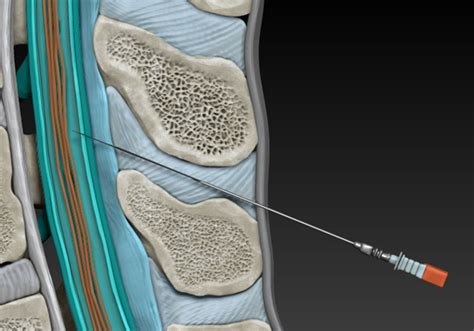 Image result for Spinal Tap Stumpy