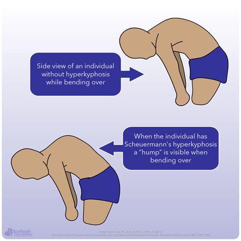 Kyphosis and Hyperkyphosis - What it is, how it happens, and what to do