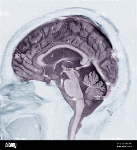 Alzheimer's disease. Sagittal magnetic resonance imaging (MRI) scan of the brain of a patient ...