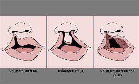 Bilateral Cleft Lip Palate