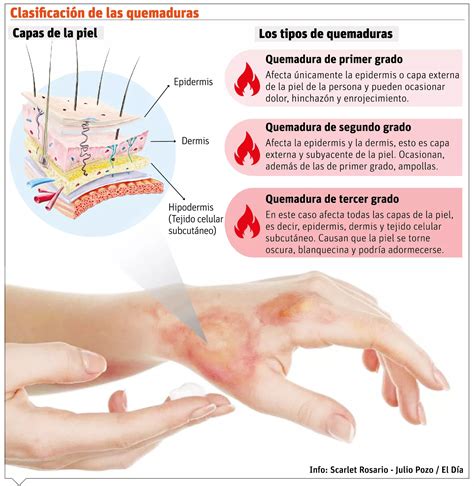 Quemaduras Primer Grado Quemaduras