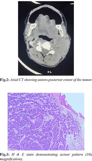Primary Intestinal-type Adenocarcinoma of the Tongue: A Rare Clinical ...