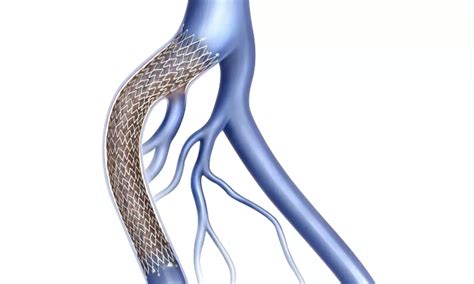Iliac vein stenting safe procedure for office-based laboratory setting ...