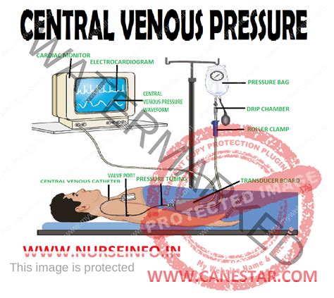 CENTRAL VENOUS PRESSURE - Nurse Info