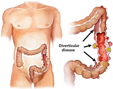 What Is Moderate Sigmoid Diverticular Disease - Design Talk