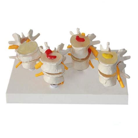 Buy Anatomy Model, Assembly Lumbar Spine Diseased Model 4- Stage Human ...