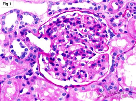 Focal Segmental Glomerulosclerosis Tip Variant | Teaching Points