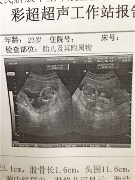 怀孕十六周多看B超图片能看出男孩女孩吗 - 百度宝宝知道