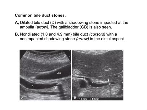 Bile duct Ultrasound | PPT