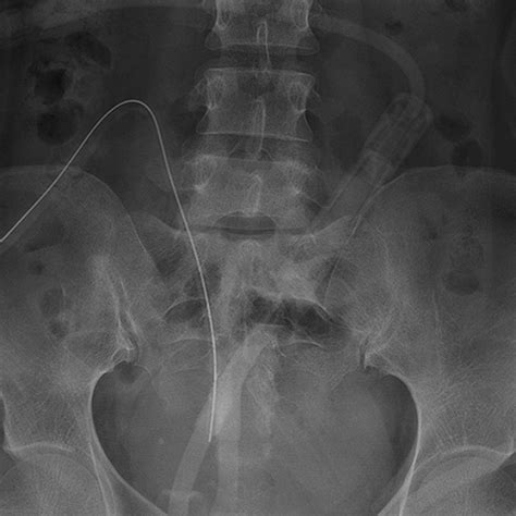 About Your Tenckhoff Catheter _ EN Tenckhoff Chronic Peritoneal Dialysis Catheters and Sets – XCBUBJ