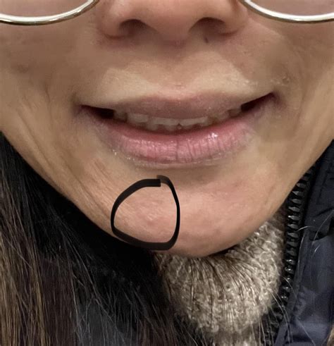 Bump on chin : r/medical_advice
