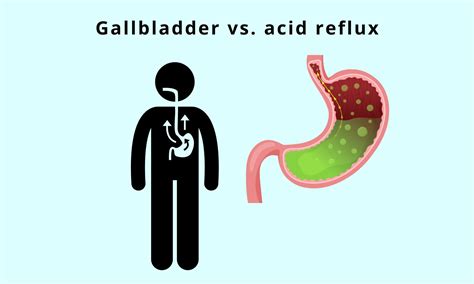 Gallbladder Acid Reflux