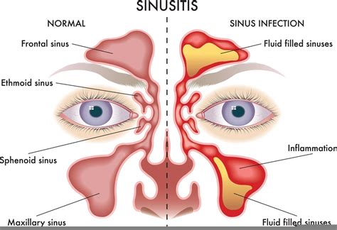Maxillary Sinus Infection Acute Sinusitis: A Cost Effective Approach
