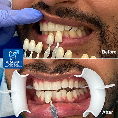 Teeth Whitening
