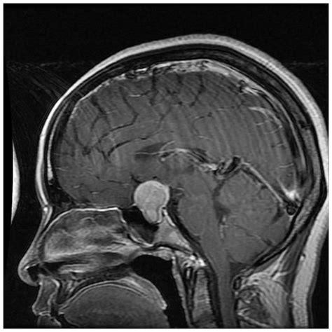 Pituitary Tumor Mri