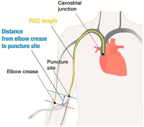 Picc Line And Arrhythmia - Infoupdate.org