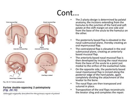Velar Pharyngeal Insufficiency
