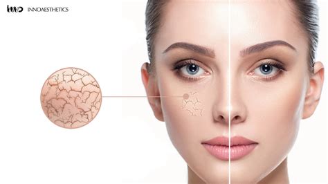 Xerosis Dry Skin (Xeroderma): Causes, Treatments, And More DermNet