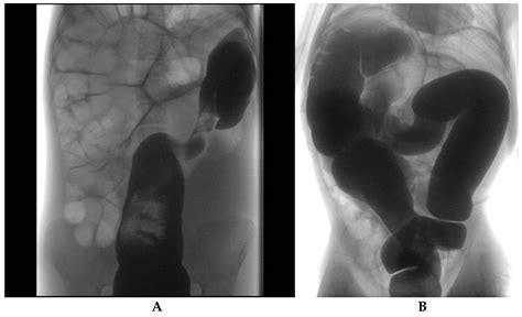 Sigmoid Volvulus Birds Beak