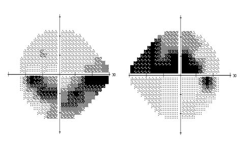 Image result for Visual Field Chart