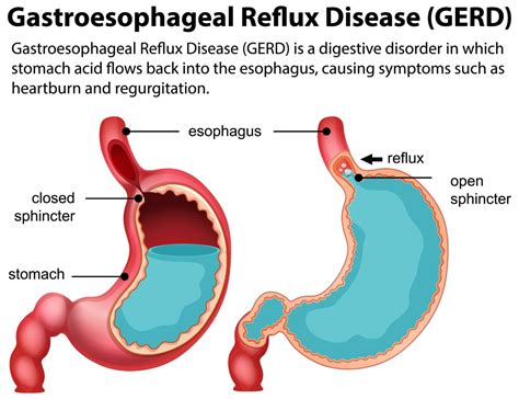Best GERD Treatment - Ayurveda, Home Remedies of GERD