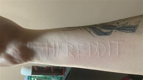 99 best Dermatographia images on Pholder | Dermatographia, Mildlyinteresting and Medizzy