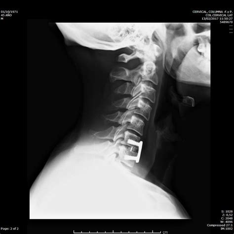 Hernia discal cervical | GEER [Sociedad para el Estudio de las ...